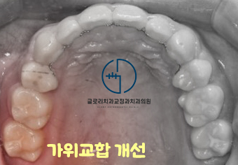 You are currently viewing 어금니가 어긋난 가위교합(sissors bite) 방치하면 턱관절에도 영향을?! 면목동 교정치과