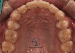 Read more about the article 상봉동 치과 에서 볼을 깨무는 습관을 개선해드렸습니다.