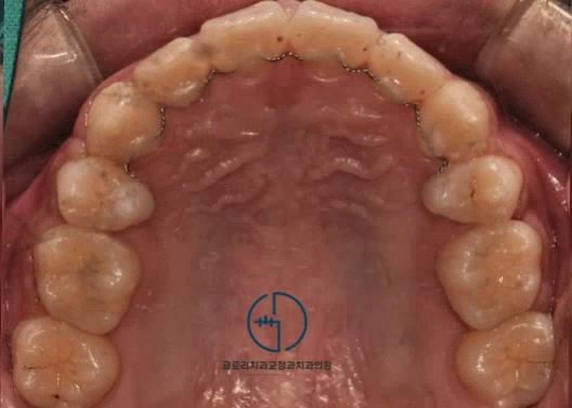 You are currently viewing 상봉동 치과 에서 볼을 깨무는 습관을 개선해드렸습니다.