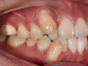 Read more about the article 면목동 치과 추천 덧니 치아교정 과정, 발치교정 당기기로 앞니 치열 개선