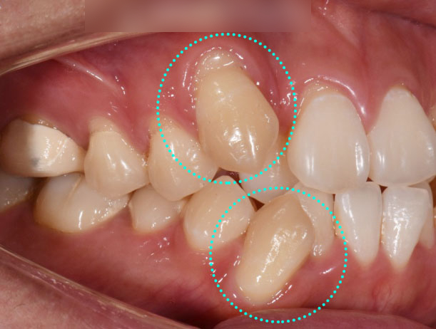 You are currently viewing 면목동 치과 추천 덧니 치아교정 과정, 발치교정 당기기로 앞니 치열 개선