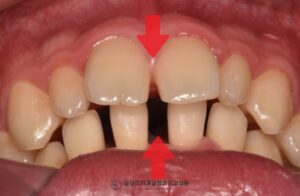 Read more about the article 영구치 결손으로 인한 임플란트 전 치아교정 단계 망우본동 치과 케이스