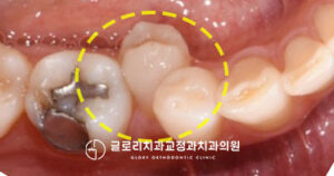 Read more about the article 면목역 치과 누워있는 치아 비발치 교정으로 해결