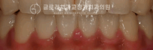 Read more about the article 1년도 채 걸리지 않은 망우동치과 비발치 치열 개선 과정