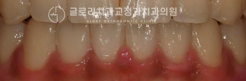 You are currently viewing 1년도 채 걸리지 않은 망우동치과 비발치 치열 개선 과정