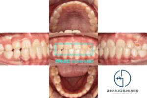 Read more about the article 거꾸로 물리는 우리 아이 치아, 망우동 교정치과 ‘프리올소’로 개선할 수 있어요!