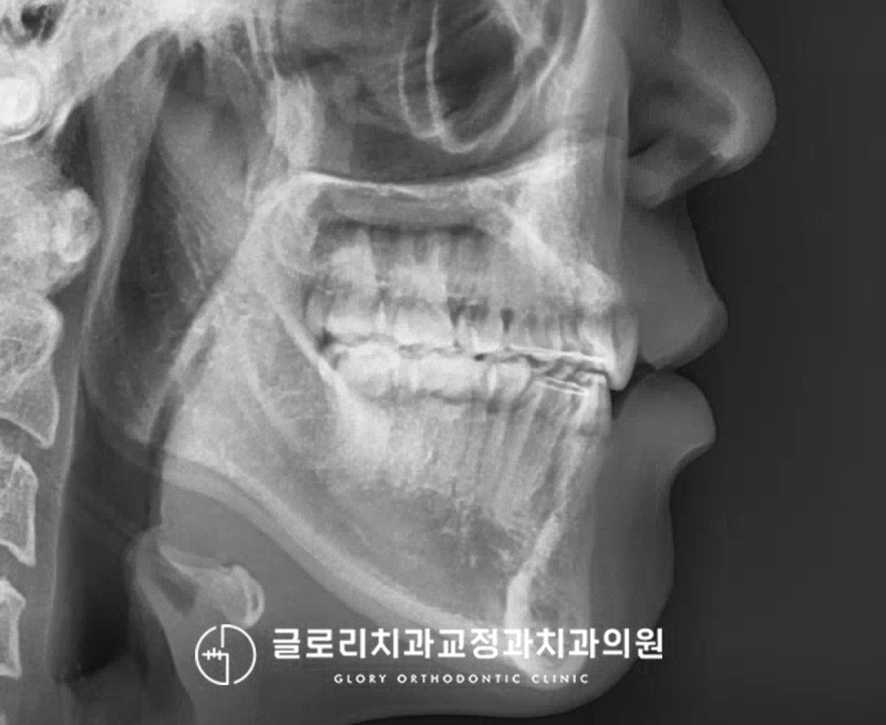 You are currently viewing 심한 돌출 및 반대교합, 하루라도 빨리 상봉동 치과 치료를 시작해야 되는 이유