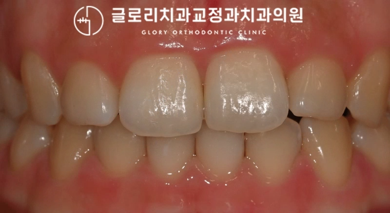 You are currently viewing 망우동치과 8개월간의 윗니 부분교정 변화 과정
