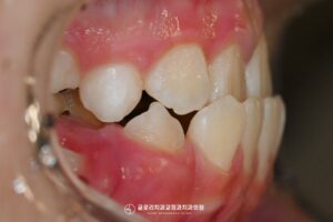 Read more about the article 앞니 거꾸로 물리는 어린이 주걱턱 교정과 반대교합 양원역 치과 에서 악궁 확장장치를 활용한 방법은?