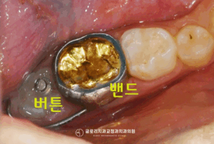 Read more about the article 중화동 치과 “영구치가 안 나와요.” 어린이 치아교정 할터만 장치로 이소 맹출 도와드렸던 케이스