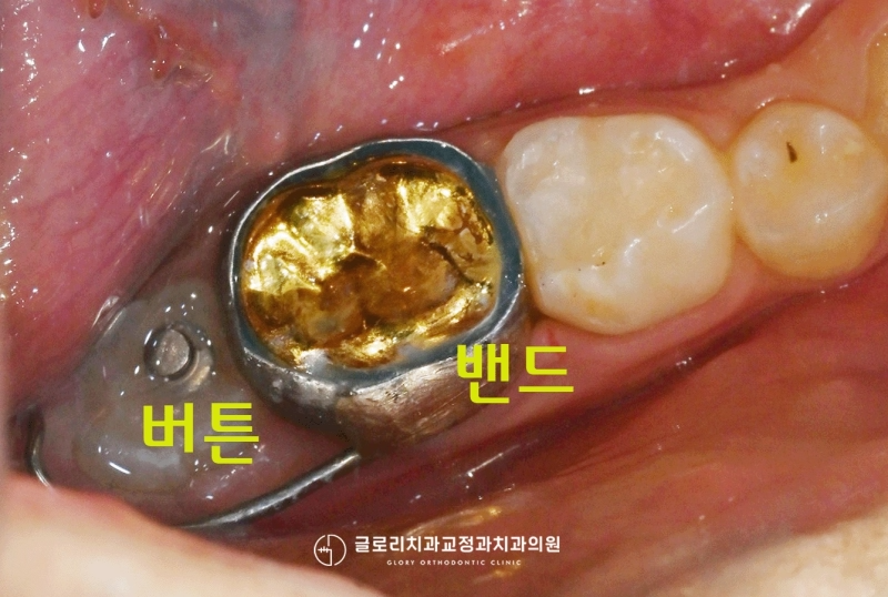 You are currently viewing 중화동 치과 “영구치가 안 나와요.” 어린이 치아교정 할터만 장치로 이소 맹출 도와드렸던 케이스