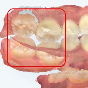 Read more about the article 눈에 보이지 않는 불편함, 망우역 교정치과 가위교합 교정치료 실제 사례