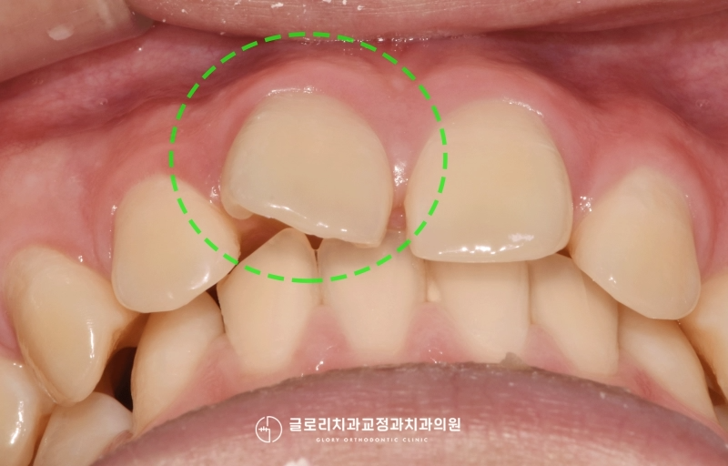 You are currently viewing 망우본동 치과 틀어진 앞니와 돌출입, 얼굴 비대칭 치아교정 클리피씨로 개선이 가능할까?
