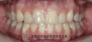 Read more about the article 망우동 글로리 치과 에서 알려드리는 치아 총생(crowding)을 발치 교정 개선