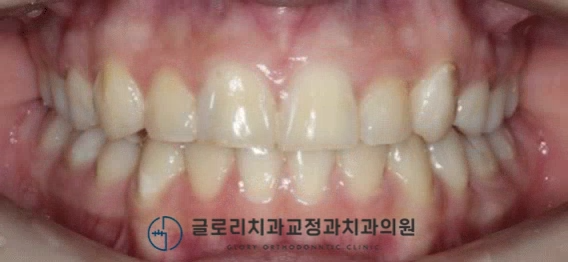 You are currently viewing 망우동 글로리 치과 에서 알려드리는 치아 총생(crowding)을 발치 교정 개선