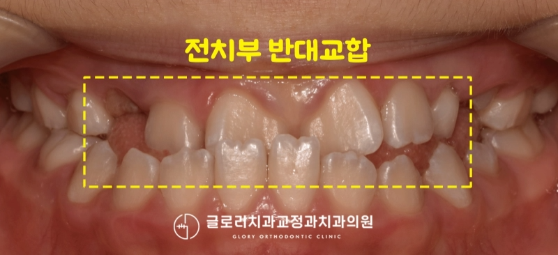 You are currently viewing ‘저희 아이 반대교합 치료를 하기에는 너무 늦은 걸까요..? 중랑구교정치과