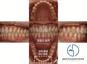 Read more about the article ‘이가 고르게 펴졌으면 좋겠어요.’ 중랑구 교정치과 치아 총생 비발치 개선 과정