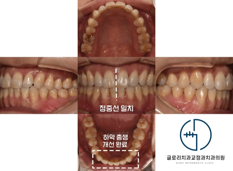 You are currently viewing ‘이가 고르게 펴졌으면 좋겠어요.’ 중랑구 교정치과 치아 총생 비발치 개선 과정