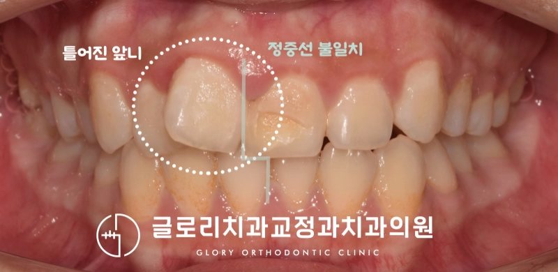 You are currently viewing “삐뚠 앞니 때문에 양치를 하는 게 힘들어요.” 치열 개선을 통해 구강 위생까지 개선 완료! 상봉동 교정치과