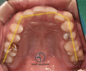 Read more about the article 중랑구 교정치과 돌출 및 치아 총생, 발치를 꼭 해야 되는 이유는 무엇일까?