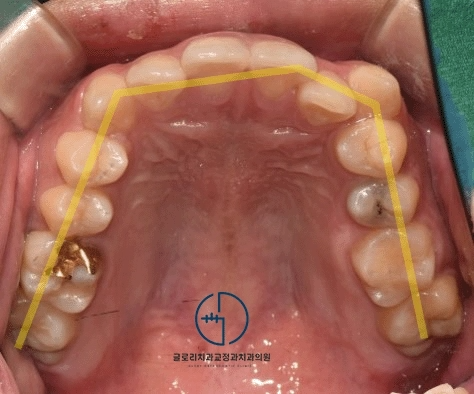 You are currently viewing 중랑구 교정치과 돌출 및 치아 총생, 발치를 꼭 해야 되는 이유는 무엇일까?