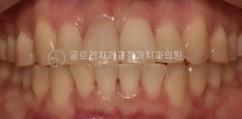 면목동치과 악궁 확장장치를 사용한 20대 치아교정 스토리