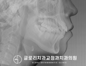 Read more about the article 신내동 치과 “입이 살짝 튀어나왔어요.” 20대 발치 교정 케이스