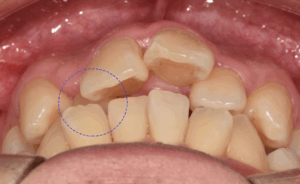 Read more about the article 앞니 뻐드렁니 및 총생 반대교합 등 다양한 문제가 있을 때 교정치료 어떻게?