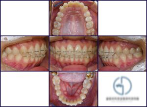 Read more about the article 앞니 살짝 틀어짐 MTA 부분 교정 치료를 통해 해결이 가능할까요?