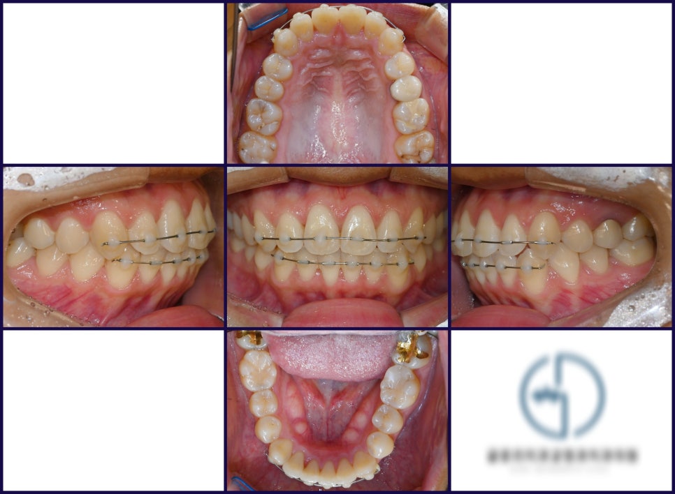 You are currently viewing 앞니 살짝 틀어짐 MTA 부분 교정 치료를 통해 해결이 가능할까요?