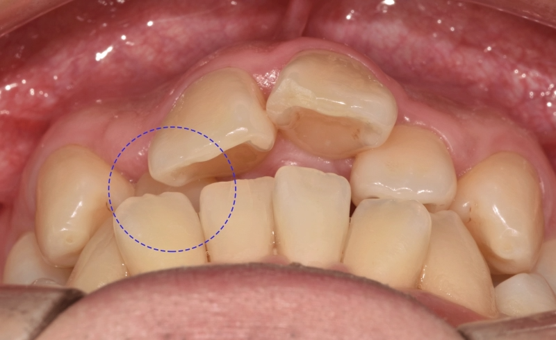 You are currently viewing 앞니 뻐드렁니 및 총생 반대교합 등 다양한 문제가 있을 때 교정치료 어떻게?