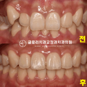 Read more about the article 덧니 때문에 발생하는 문제는 어떤 것들이 있을까? 중랑구 양원역 치과 치아교정 증례