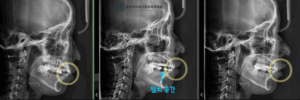Read more about the article 망우동 글로리 치과 ‘튀어나온 입이 콤플렉스에요.’ 성인 발치 교정 증례