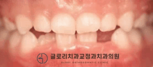Read more about the article 어린이 반대교합 교정, 기간은 얼마나 걸릴까? 상봉역 치과