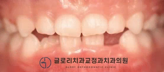 You are currently viewing 어린이 반대교합 교정, 기간은 얼마나 걸릴까? 상봉역 치과