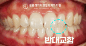 Read more about the article 망우역 치과 틀어진 앞니 치아교정 부분 반대교합 개선으로 아름다운 미소 되찾기