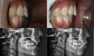 Read more about the article 티 안 나는 인비절라인으로 오랜 콤플렉스 개선 완료! 면목동 교정치과
