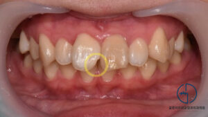 Read more about the article 중화역 신내동 교정치과 ‘치아 개수가 모자란 선천적 결손치, 어떤 방법으로 개선을 도왔을까?’