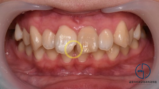 You are currently viewing 중화역 신내동 교정치과 ‘치아 개수가 모자란 선천적 결손치, 어떤 방법으로 개선을 도왔을까?’