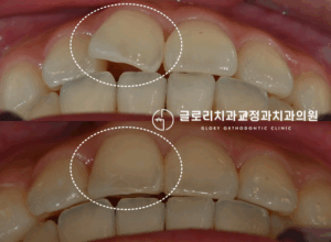 Read more about the article 한곳만 틀어진 앞니, 부분교정으로 개선할 수 있을까요? 망우동치과