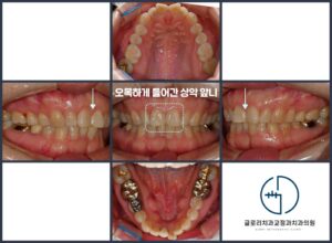 Read more about the article “앞니가 오목하게 들어가 있어요.” 중랑구 교정치과 중년 부분 개선으로 4개월 만에 고른 배열 완성