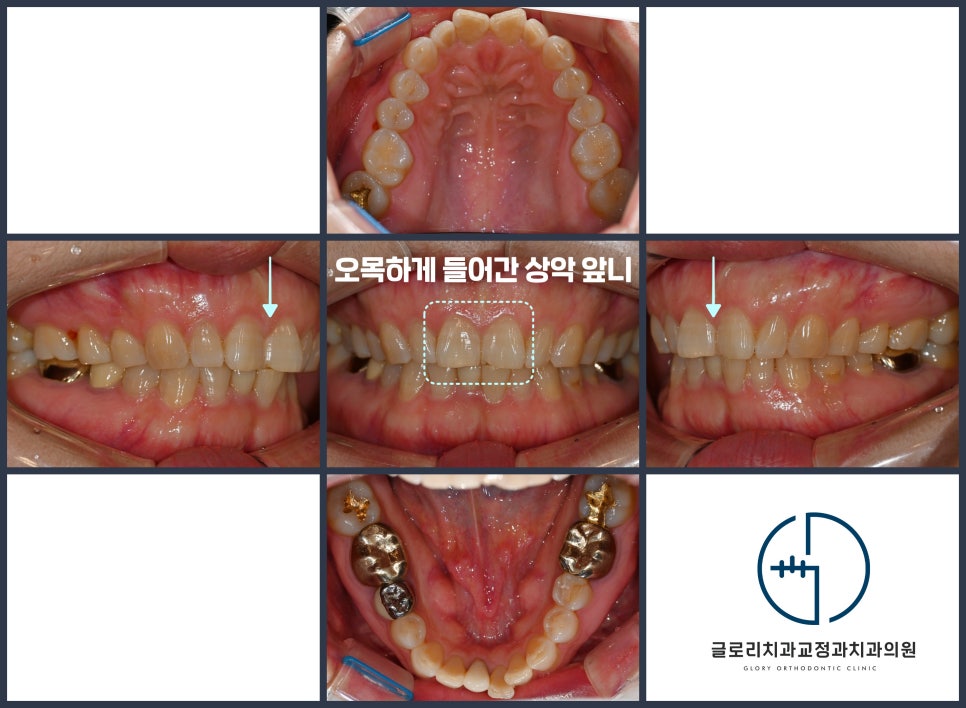 You are currently viewing “앞니가 오목하게 들어가 있어요.” 중랑구 교정치과 중년 부분 개선으로 4개월 만에 고른 배열 완성