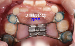 Read more about the article 어린이 부정교합 교정 RPE 구개확장장치로 교차교합 개선 완료 신내동 치과