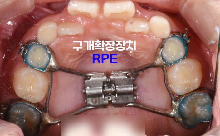 You are currently viewing 어린이 부정교합 교정 RPE 구개확장장치로 교차교합 개선 완료 신내동 치과