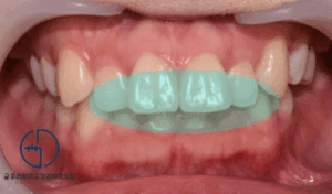 Read more about the article 치아 총생(crowding)으로 인한 콤플렉스, 망우동 교정치과 에서 해결할 수 있을까?