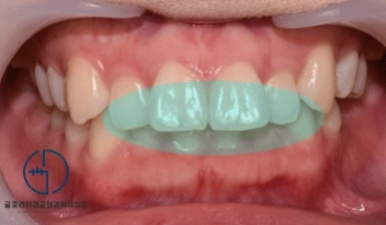 You are currently viewing 치아 총생(crowding)으로 인한 콤플렉스, 망우동 교정치과 에서 해결할 수 있을까?