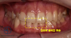 Read more about the article 양원역 교정치과 : 반대로 물리는 치아 이렇게 바뀔 수 있어요!