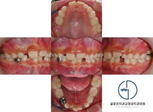 Read more about the article 고르지 않은 혼합치열기 치아 배열 중랑구 치과 에서 진행한 어린이 교정치료 사례