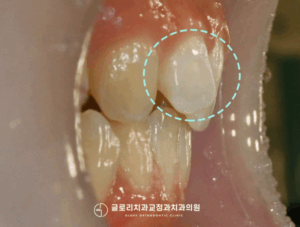 Read more about the article 인비절라인 투명교정, 치아 재교정으로 가능할까? 면목동 치과