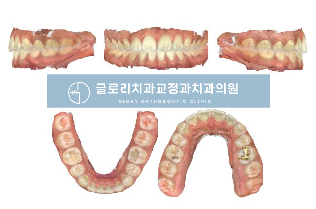 중랑구교정치과 디지털 스캔 및 투명장치를 사용한 벌어진 치아(spacing) 개선 과정